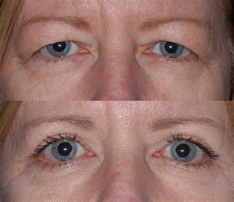 Blepharoplasty, or eyelid surgery, without a scar is possible for the lower eyelids by going through the inside of the eye to remove the deposits of fatty tissue. Eyelid Surgery Miami | Upper Eyelid Surgery Maimi | CEEC