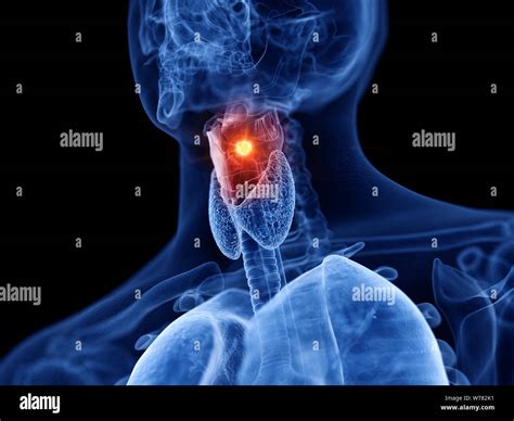 Menschlicher Larynx Tumor Fotos Und Bildmaterial In Hoher Aufl Sung