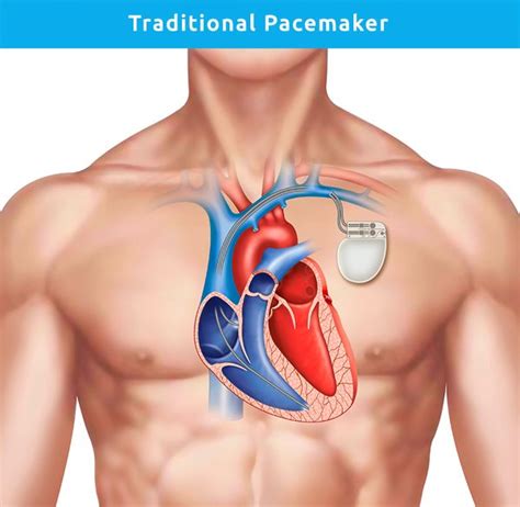 Implantation Of Leadless Pacemakers Professor Kevin P Walsh