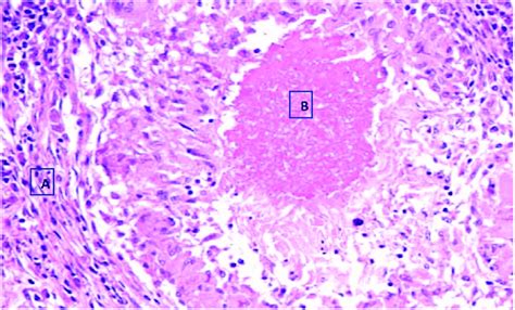 Histopathology Of Btb Suspected Tuberculous Lesioned Lymph Node With