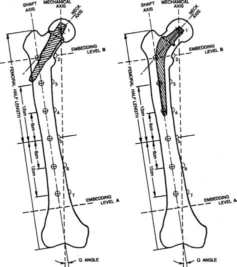 Schematic Diagram Of Femoral Marking Scheme Axes And Angles Showing