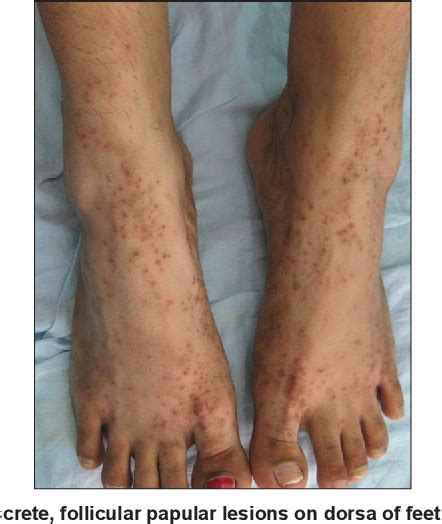 Figure 1 From Hyperkeratosis Lenticularis Perstans Case Report Of A