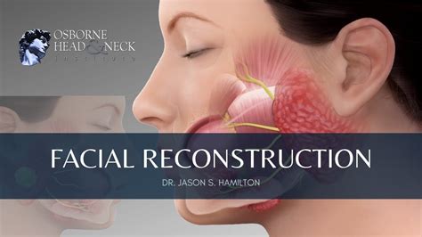 Facial Reconstruction After Parotid Gland Surgery Explained By Dr