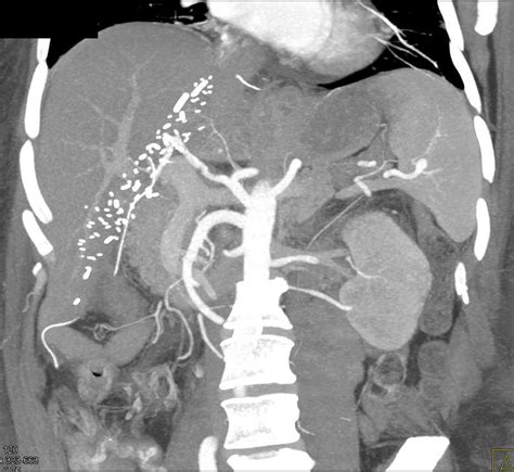 Hepatic Artery Stenosis In A Liver Transplant Patient Liver Case