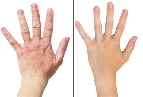 Natural Psoriasis Treatment How Pemf Therapy Can Help