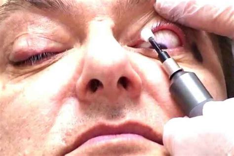 Eyelashes Infested With Mites Demodex Mites Eye Mites
