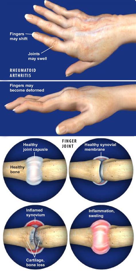 Rheumatoid Arthritis Ra Of The Hand Arthritis Foundation Approved