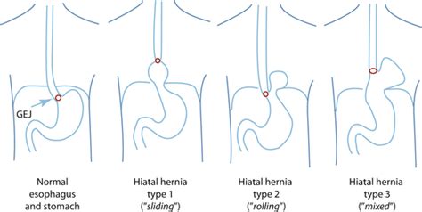 Utility Of Endoscopy In The Diagnosis Of Hiatus Hernia And Correlation