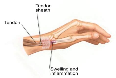 In most cases, de quervain's is caused by. Focus On De Quervain's Tenosynovitis | A+ Physio