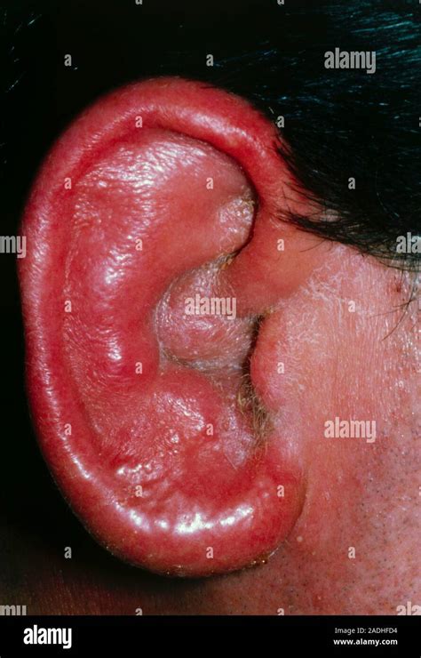 The Ear Of A Person Suffering From Acute Otitis Externa Inflammation