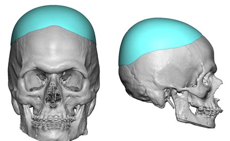 Blog Archivecase Study Secondary Custom Skull Implant Replacement
