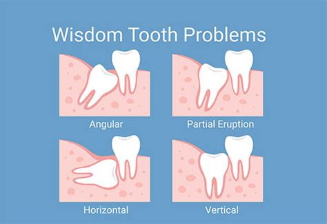 Wisdom Teeth Diagram