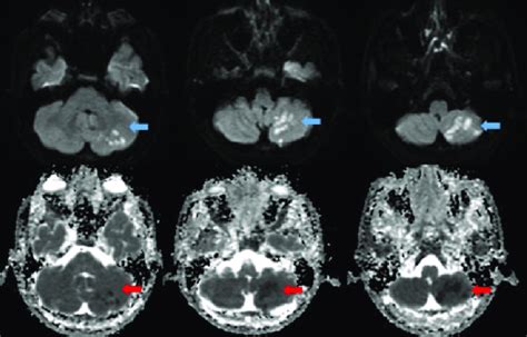 The Acute Infarct Area In The Left Cerebellar Hemisphere Is Indicated