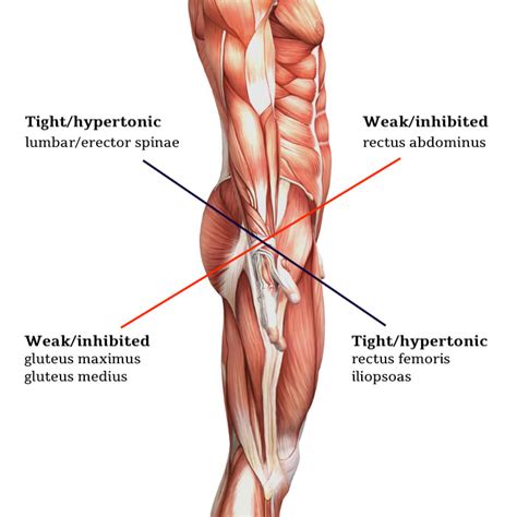 Lower Crossed Syndrome Your Physio