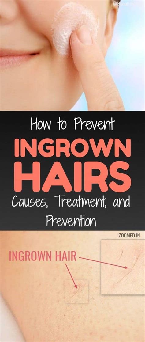 How To Prevent Ingrown Hairs Causes Treatment And Prevention