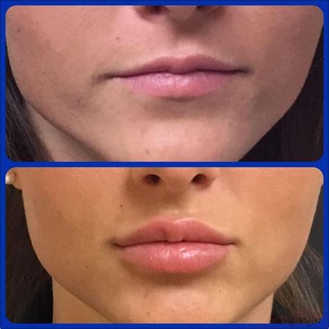 1 2 Syringe Juvederm Lips Before And After My Xxx Hot Girl