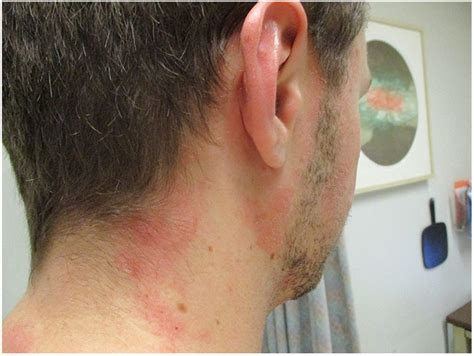 Recalcitrant Seborrheic Dermatitis Successfully Treated With Apremilast