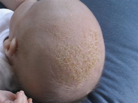 What Is Cradle Cap Panorama Dermatology Clinic