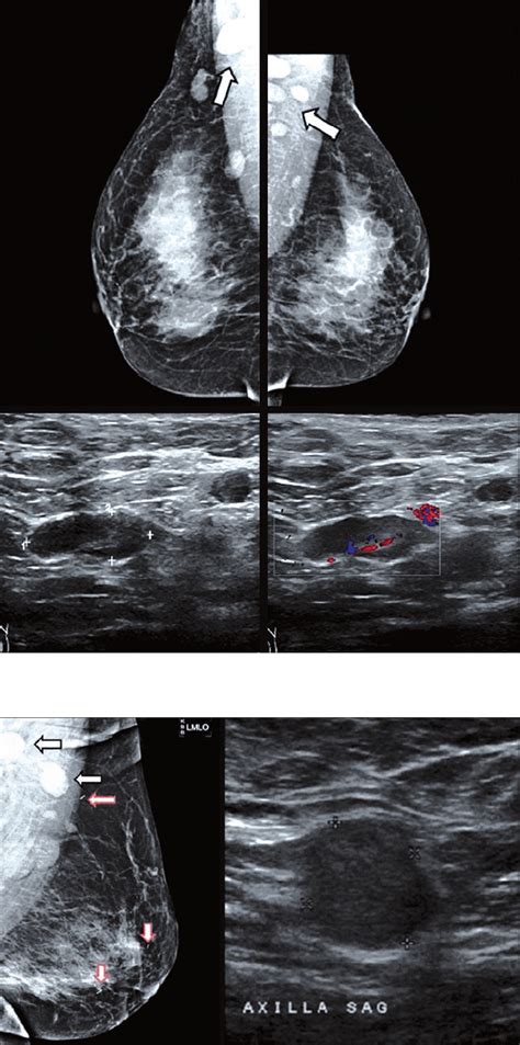 Abnormal Axillary Lymph Nodes On Negative Mammograms Causes Except