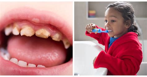 Almost 180 Children Are Having Rotting Teeth Removed Every Day Netmums