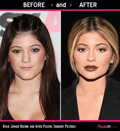 old kylie jenner lips and faces plastic surgery before and after pic 9 in 2020 kylie jenner