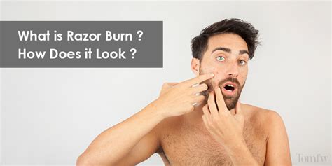 How To Prevent Razor Burn How To Get Rid Of Razor Burn