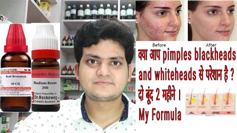 Homeopathic Medicine For Acne Pimples Blackheads Whiteheads My
