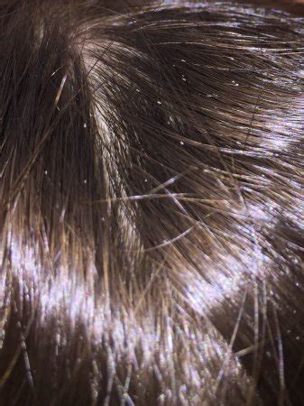 Does this look like lice? Pic - BabyCenter
