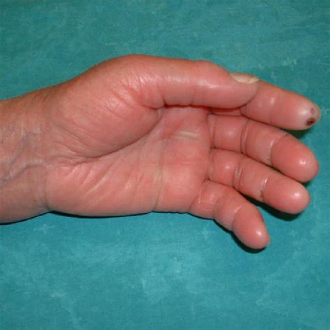 Partial Necrosis Of The Ii Finger Of The Left Hand Download