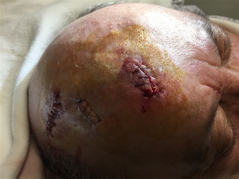 Scalp laceration repair with sutures - Closing the Gap