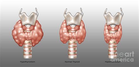Thyroid Disorders Vs Normal Photograph By Gwen Shockey Pixels