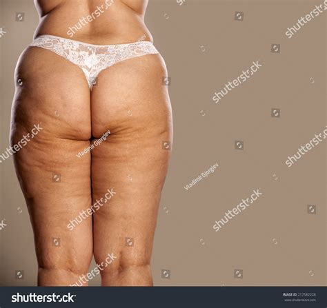 Female Buttocks Legs Cellulite Stretch Marks Stock Photo Shutterstock