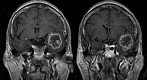 Sometimes, people with a brain tumor do not have any of these changes. Malignant Brain Tumors