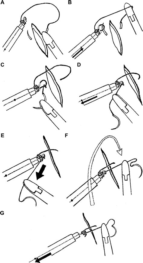 Integrating Laparoscopic Intracorporeal Suturing And Knot Tying Into A
