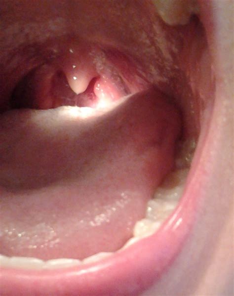 Nodules In Throat Porn Website Name