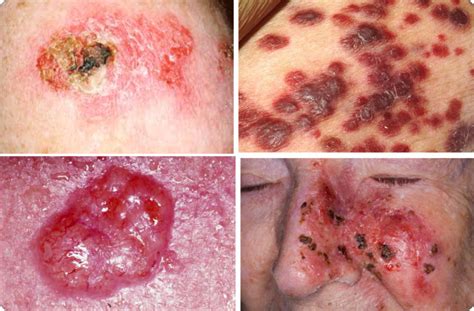 3 Types Of Skin Cancer Cancer Blog