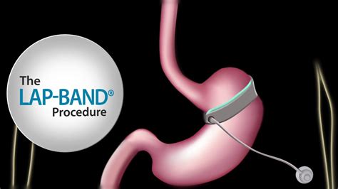 Fast Facts About The Lap Band Procedure Youtube