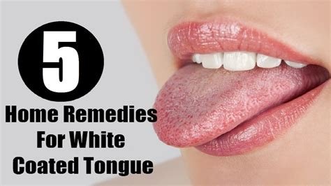 5 Home Remedies For A White Coated Tongue By Top 5 Youtube