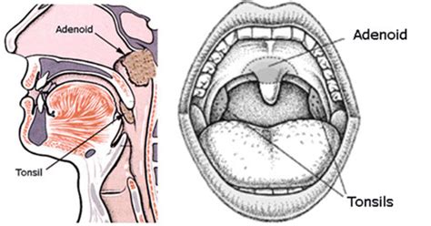 When Is Adenoid Removal Necessary Ent Clinic