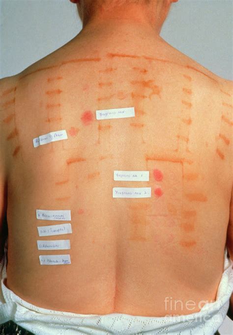 The Results Of A Patch Test On A Patients Back Photograph By John