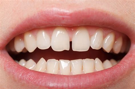 How are gapped teeth treated? Struggling with Fixing Your Front Teeth Gap?