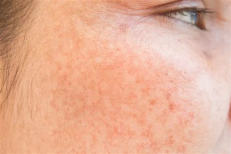 What Causes Brown Spots On Your Skin