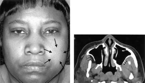 Buccal Fat Pad Hemorrhage After Retrobulbar Injection American