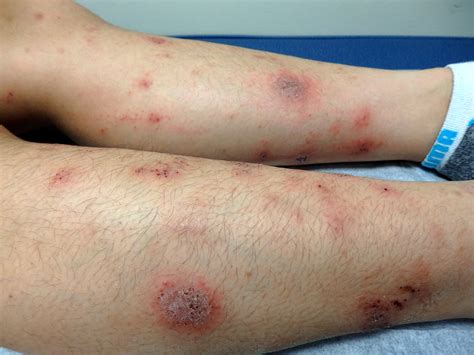 Nummular Eczema Nummular Dermatitis Pediatric Dermatology