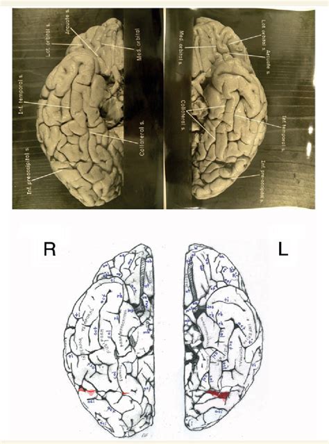 Albert Einstein Real Brain