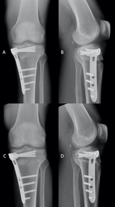 High Tibial Osteotomy X Ray