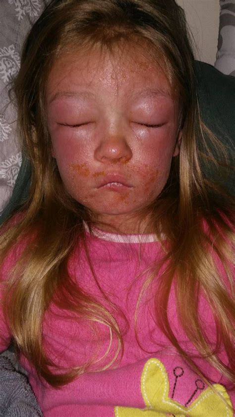 6 Year Old Develops Serious Infection After Swimming At Virginia Beach