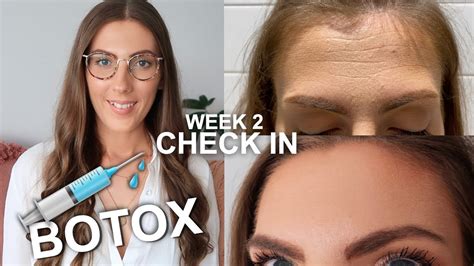 2 Weeks After Botox Daily Updates And Results Fixing Spock Eyebrows