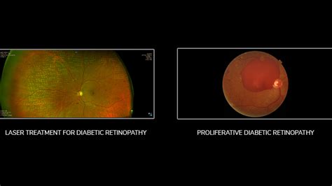Diabetic Retinopathy Laser Treatment Recovery Time Carleyrindler