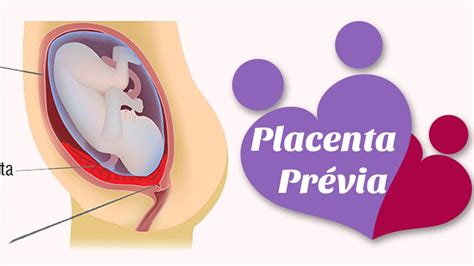 Placenta Prévia Youtube